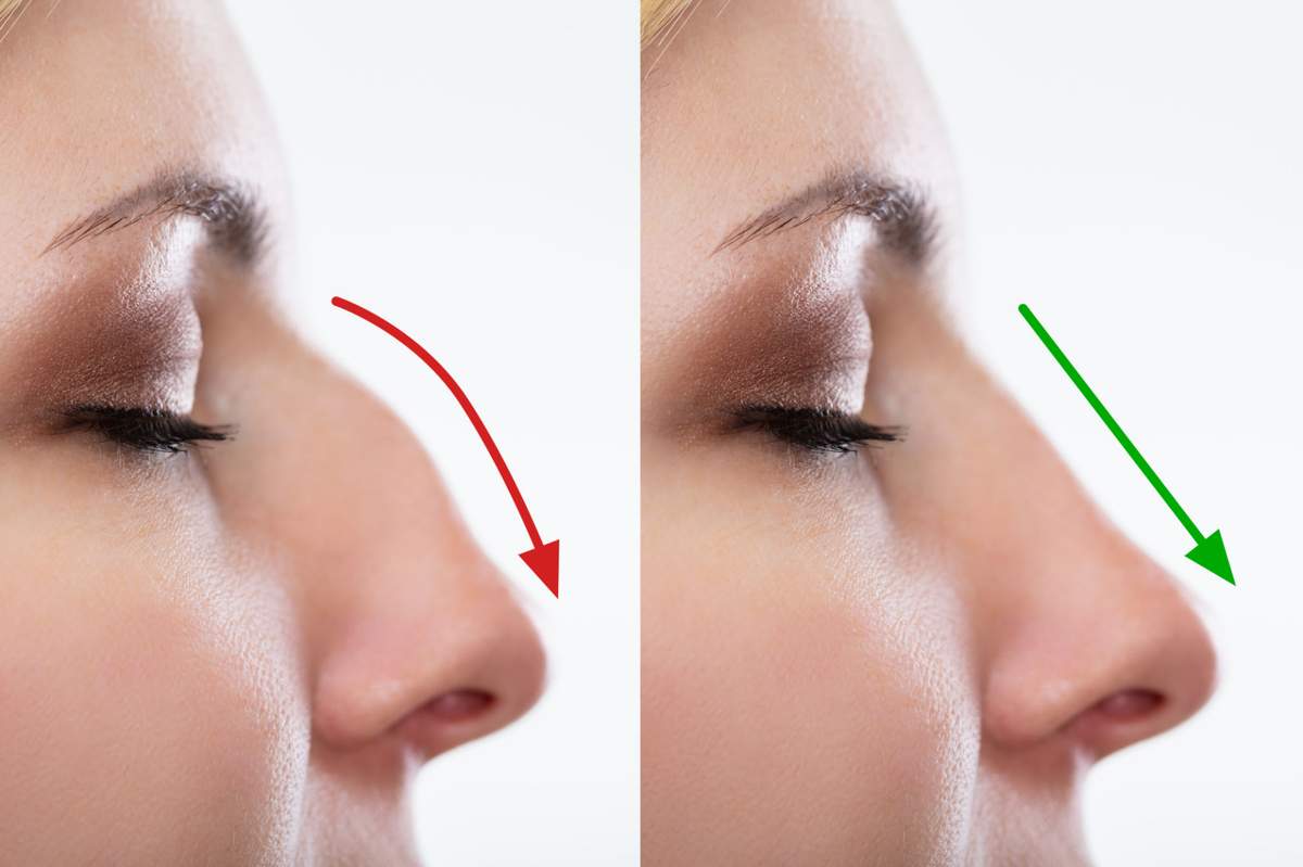 Nose Aesthetics Bodrum Rhinoplasty Bodrum