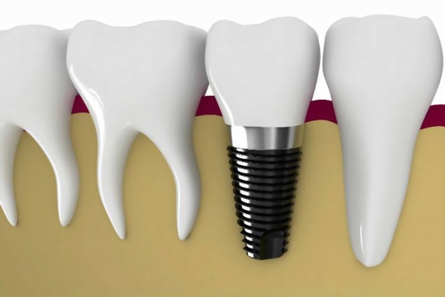 Implants Bodrum, Dental implant Bodrum