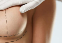 Breast Lift Mastopexy Breast Lift Mastopexy