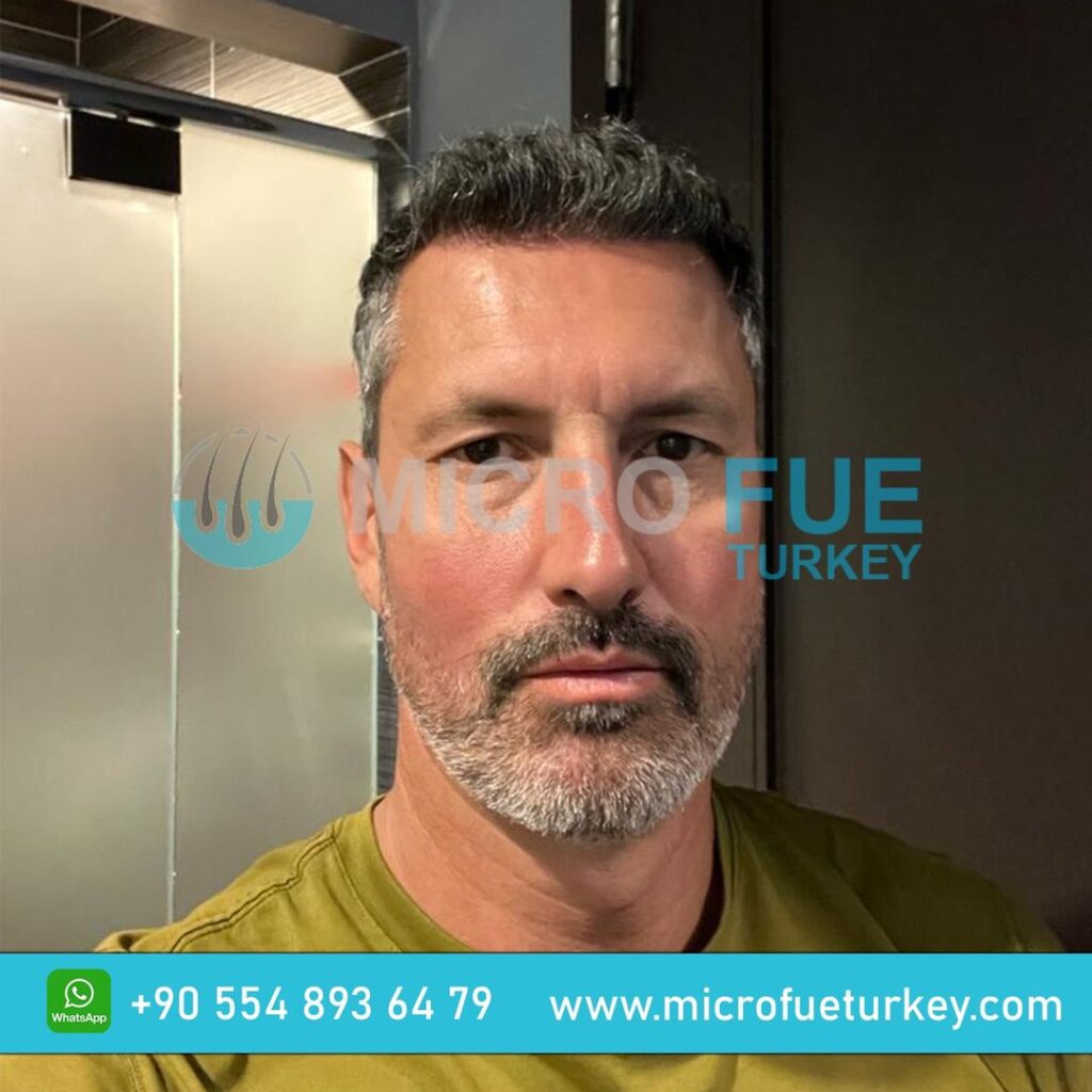 Izmir Hair Transplant