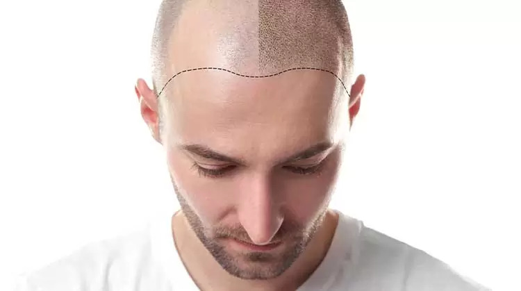 Hair Transplant