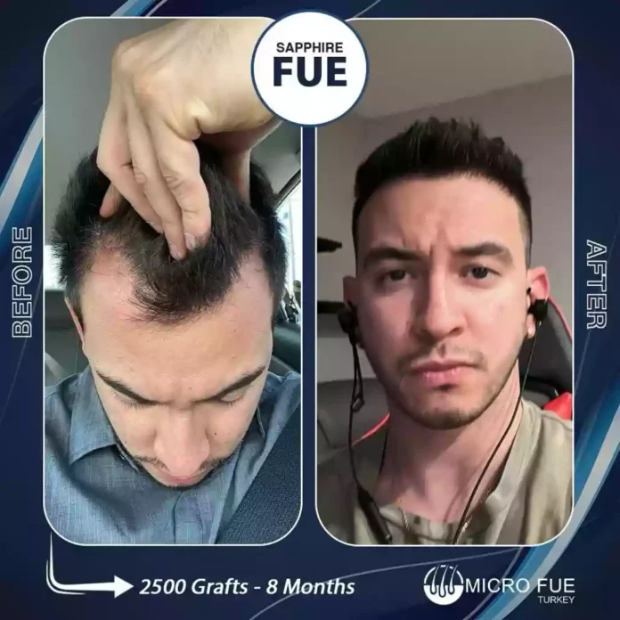 Micro Fue Hair Transplant Bodrum