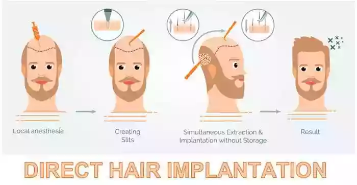 DHI Method Direct Hair Implantation
