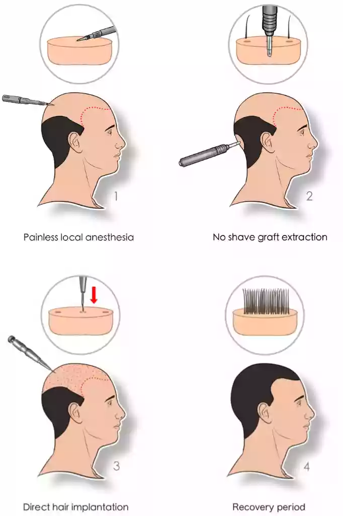 DHI Method Direct Hair Implantation