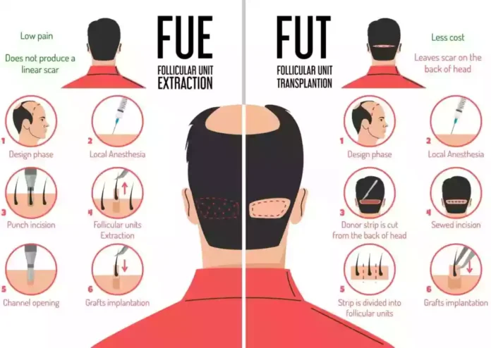Follicular Unit Extraction [FUE] 