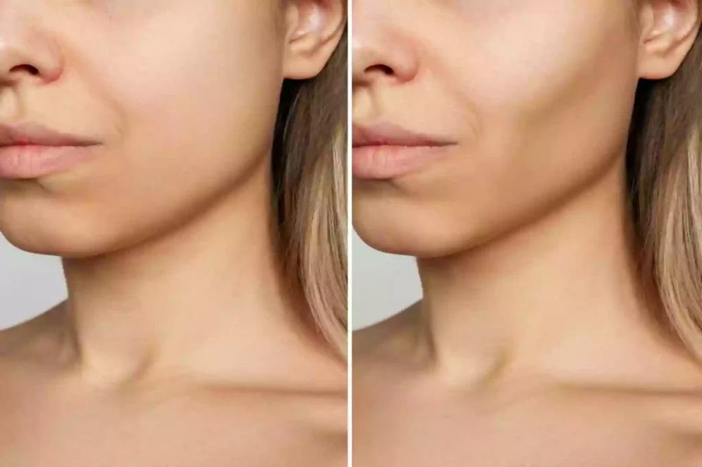 Face Filling Applications Bodrum