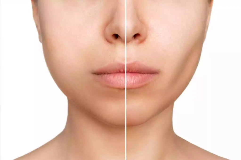 Fat Injection to The Face Bodrum