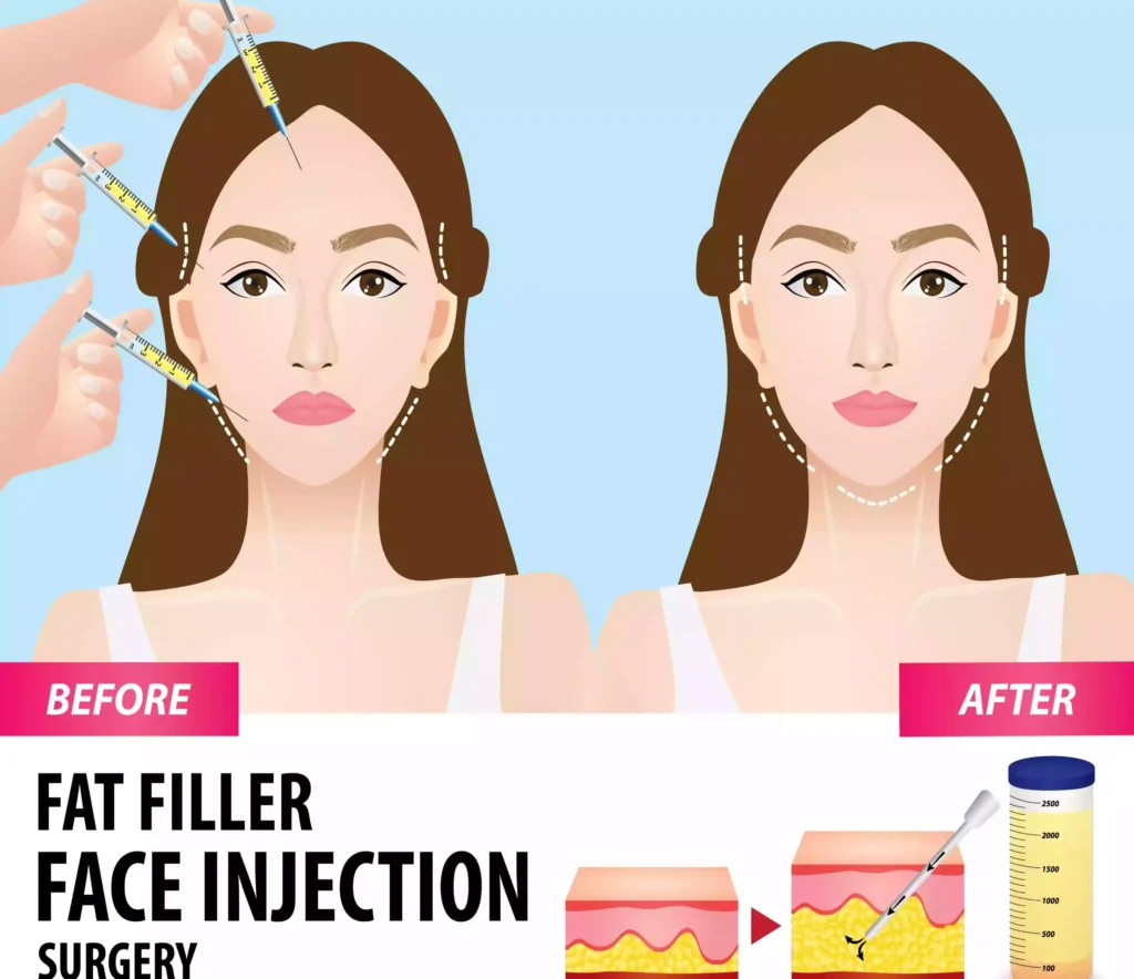 Fat Injection to The Face Bodrum