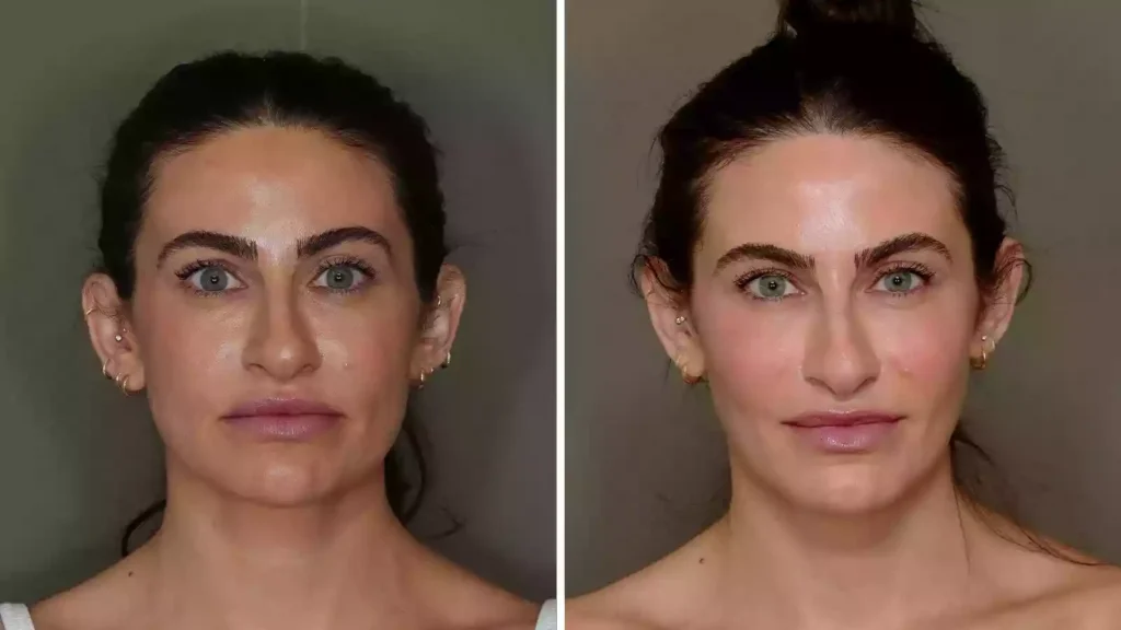 Fat Injection to The Face Bodrum