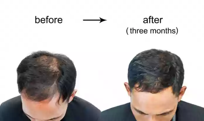 Best Hair Transplant Clinics in Antalya Prices
