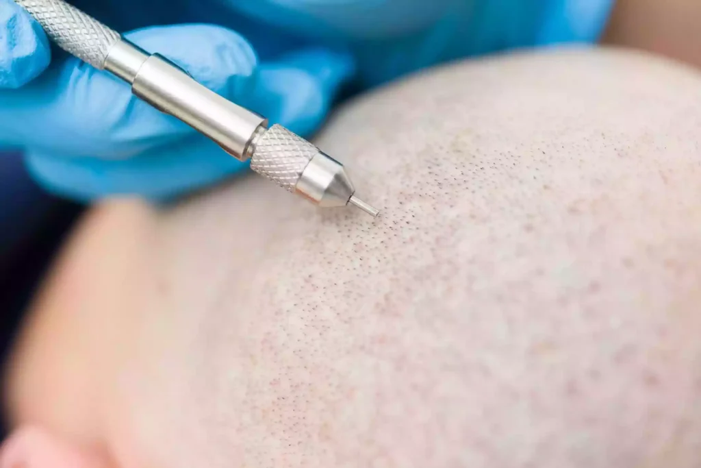 Turkey Best Hair Transplantation Centers