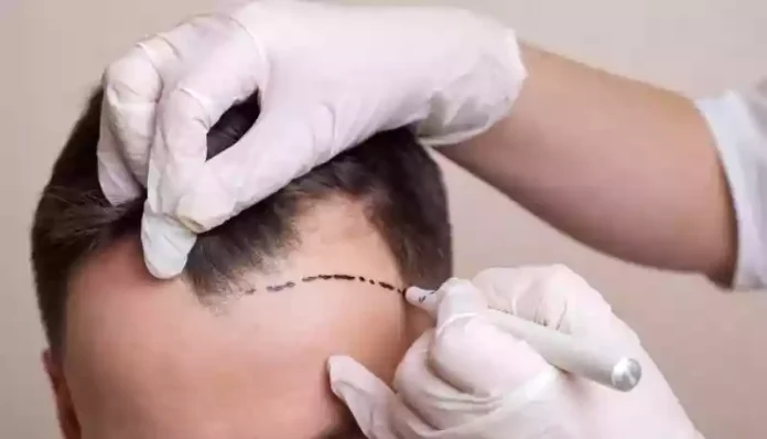 Antalya Hair Transplant