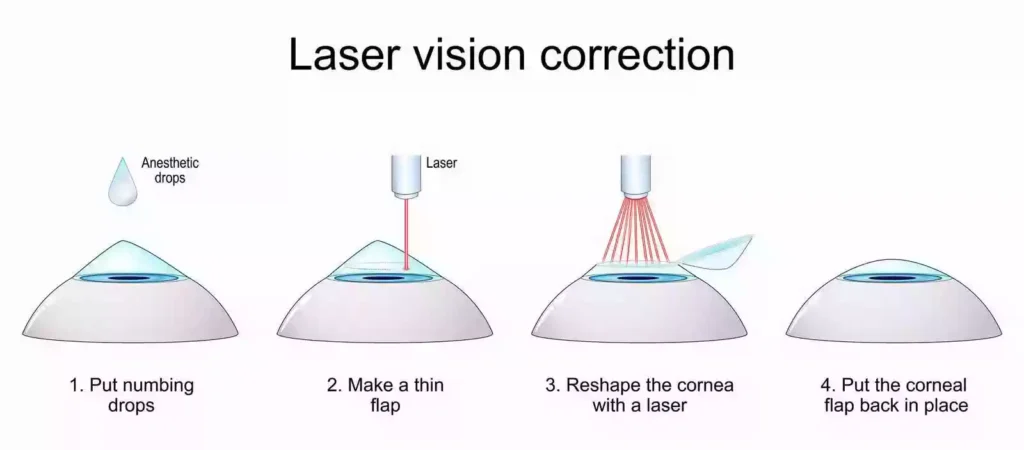 Laser Treatment For Eyes