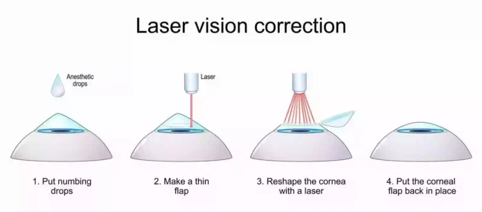 Laser Treatment For Eyes
