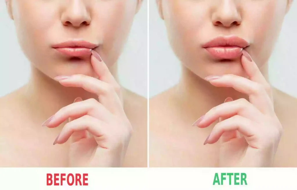Lip Filler Bodrum