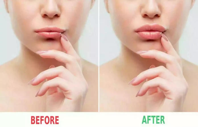 Lip Filler Bodrum