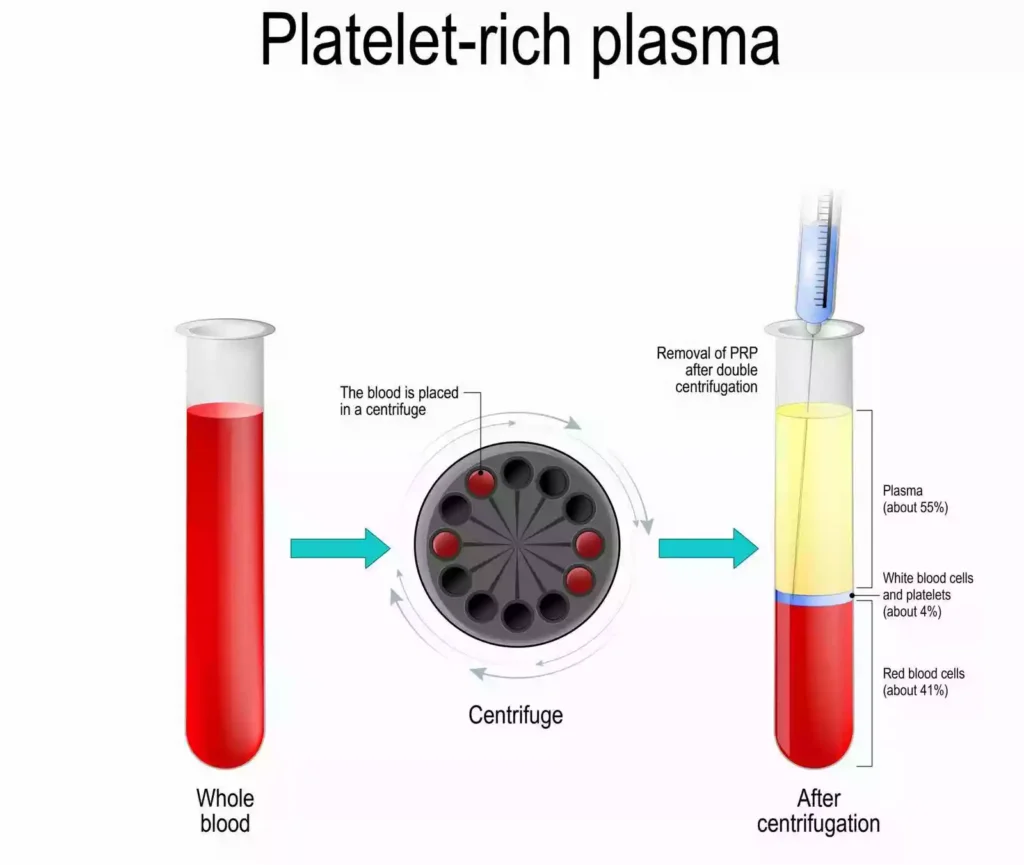 PRP Application Bodrum