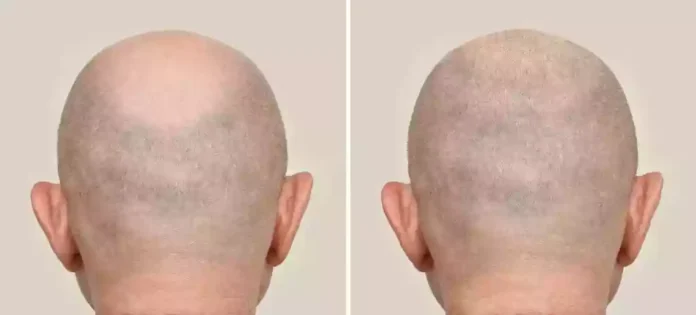 Izmir Hair Transplant