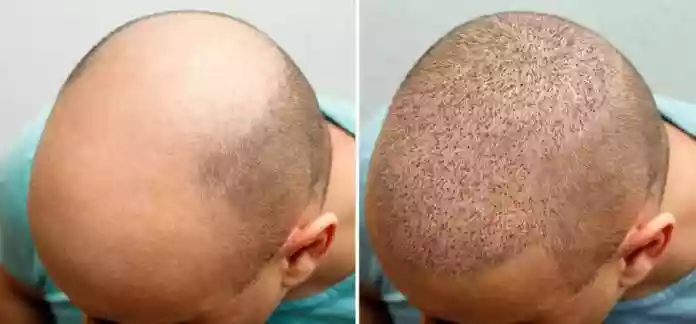 Hair Transplant Marmaris Turkey