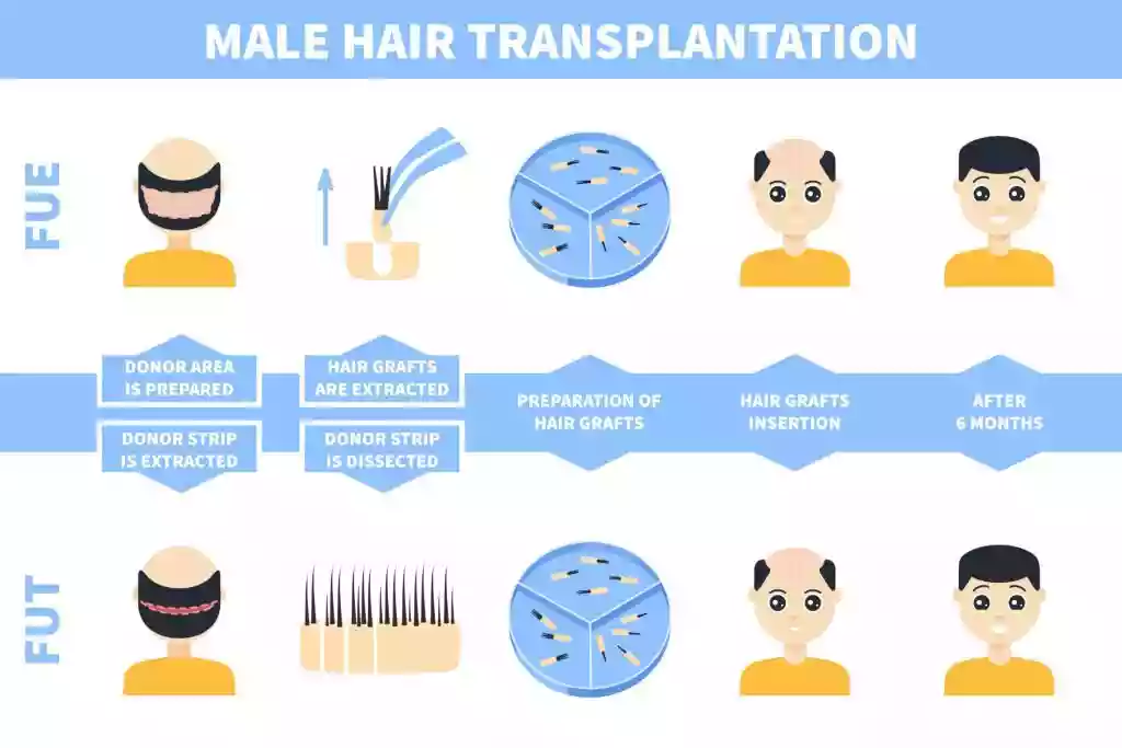 Hair Transplant Marmaris Turkey