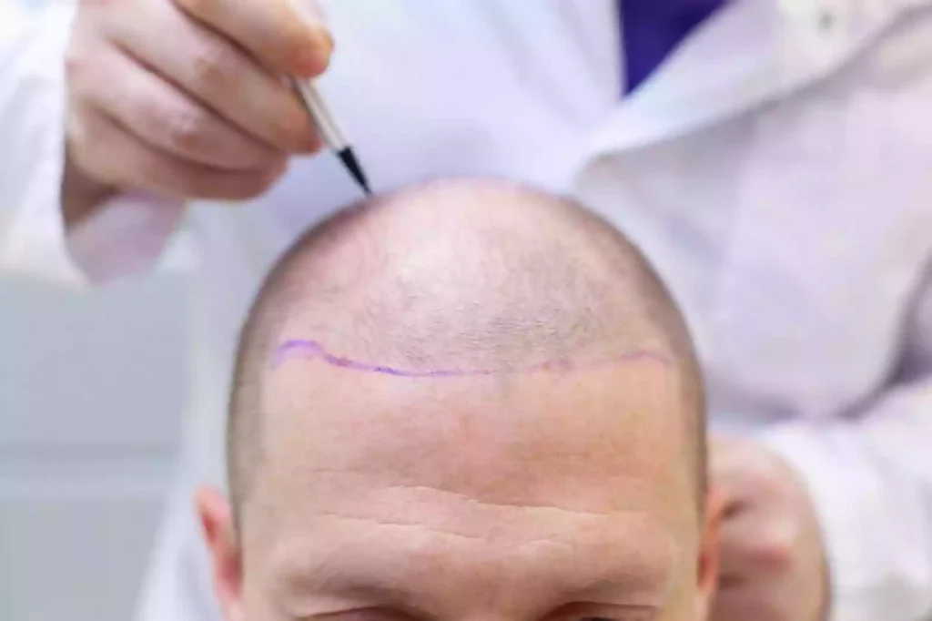 Hair Transplant Marmaris