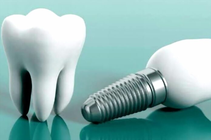 Implants Bodrum-2 Implants Bodrum, Dental Implant Bodrum