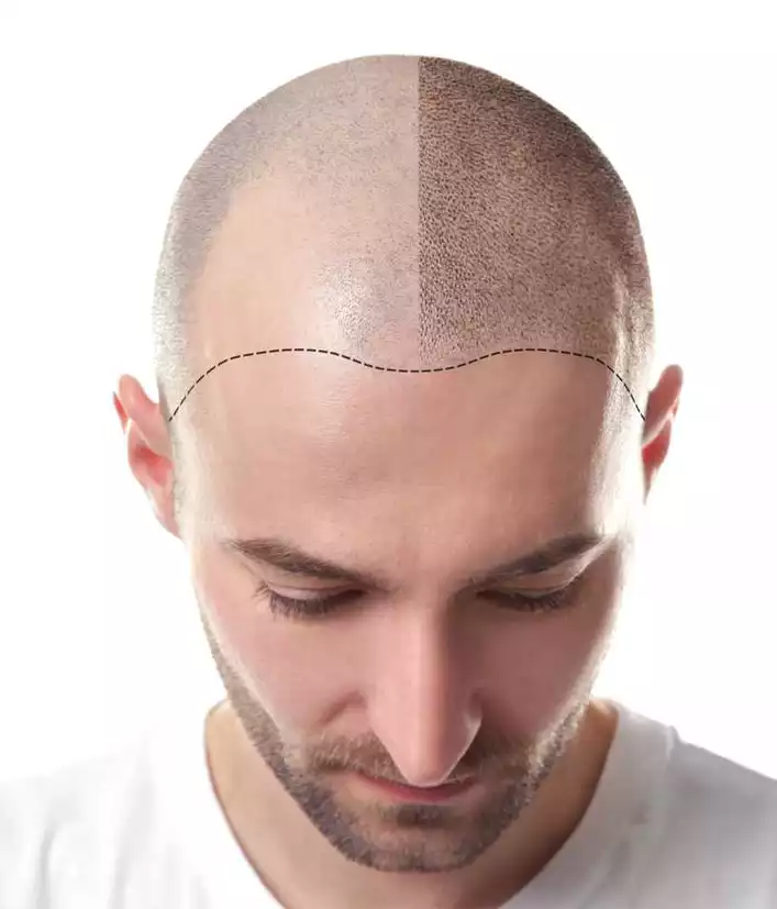 Hair Transplant Bodrum Turkey